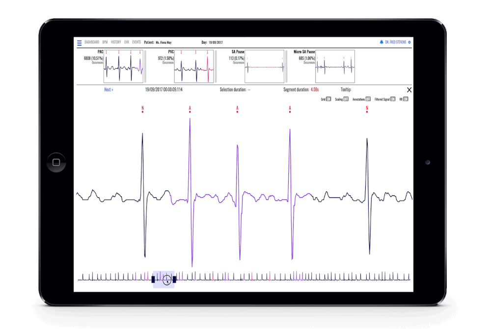 Atrial Arrhythmia